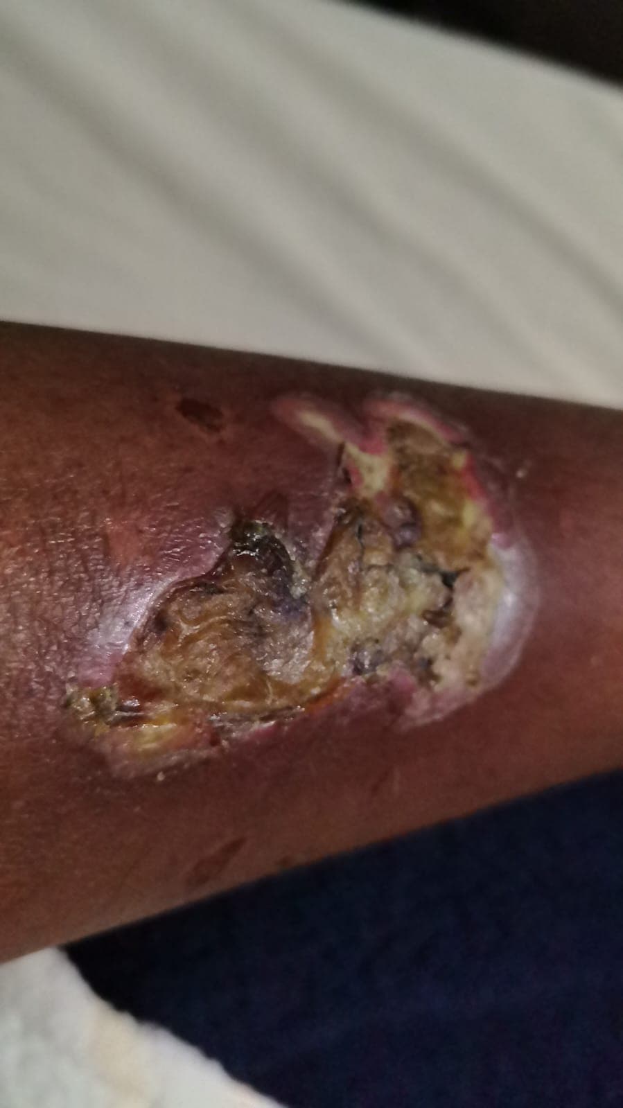 Burn wound before and after God's healing